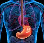 7 de cada 10 mexicanos tienen la bacteria “helicobacter pylori”, vinculada al cáncer gástrico